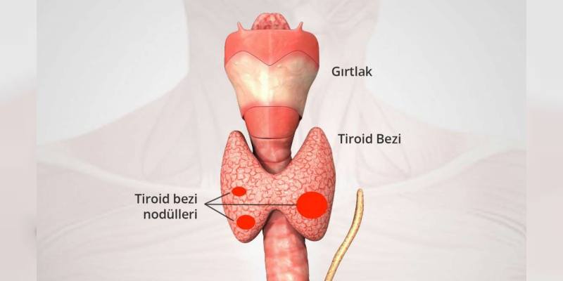 tiroid nodulleri doc dr orhan celen